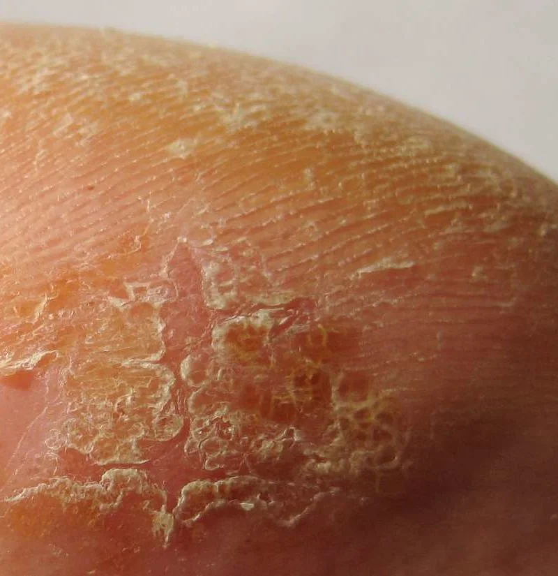 Picture of skin condition peeling