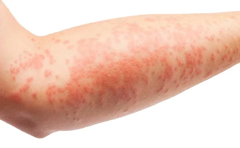 Picture of Atopic dermatitis