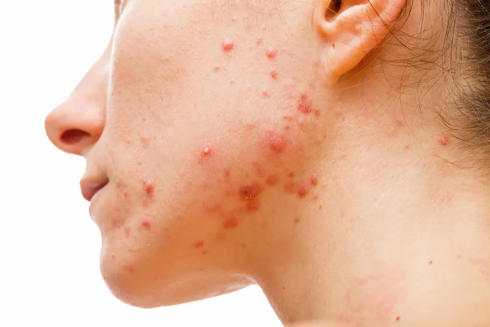 Picture of face cheek with acne