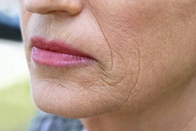 Picture of Aging Facial Skin Menopause