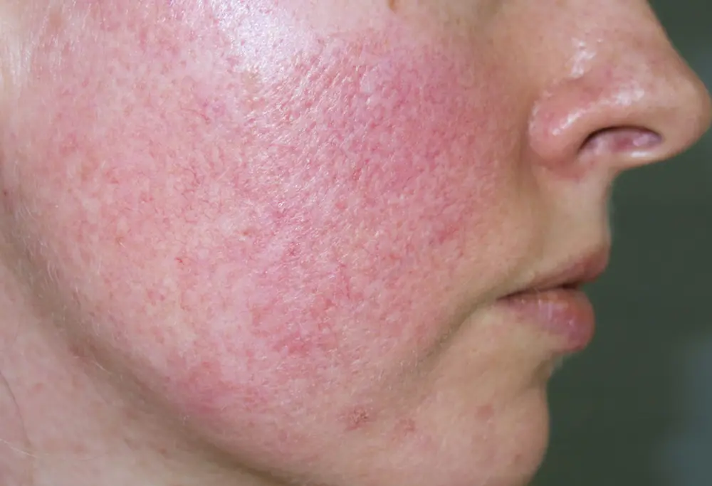 Picture of face cheek with acne