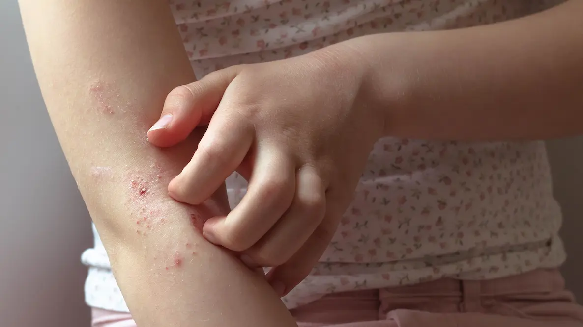 Picture of scratching eczema on arm